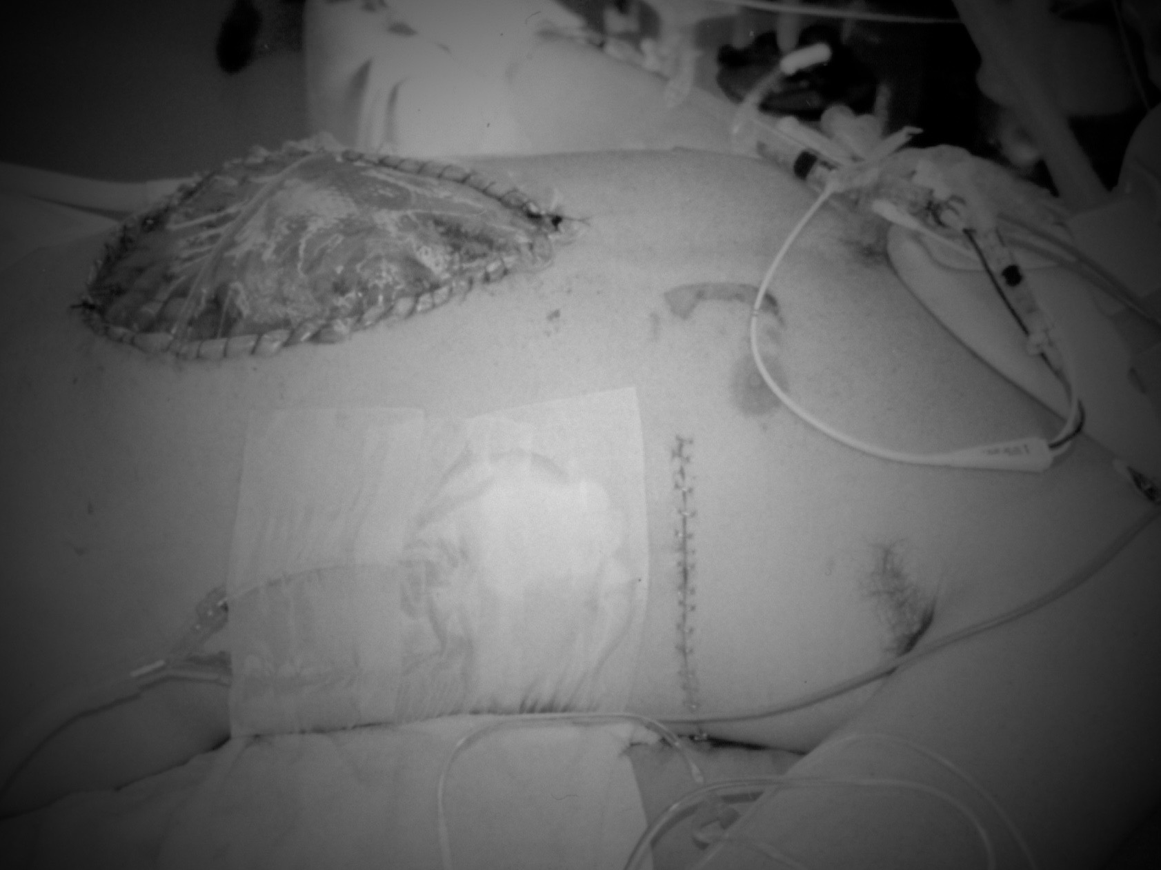 A very muted photo of Lee after his initial life-saving surgery.